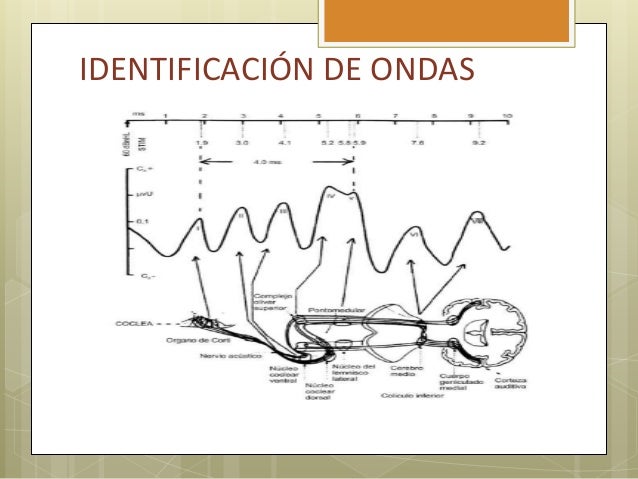 potenciales evocados auditivos